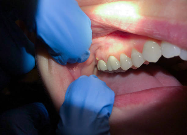 Best Lost Filling or Crown Replacement in East Whittier, CA